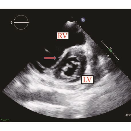 d shaped left ventricular septum